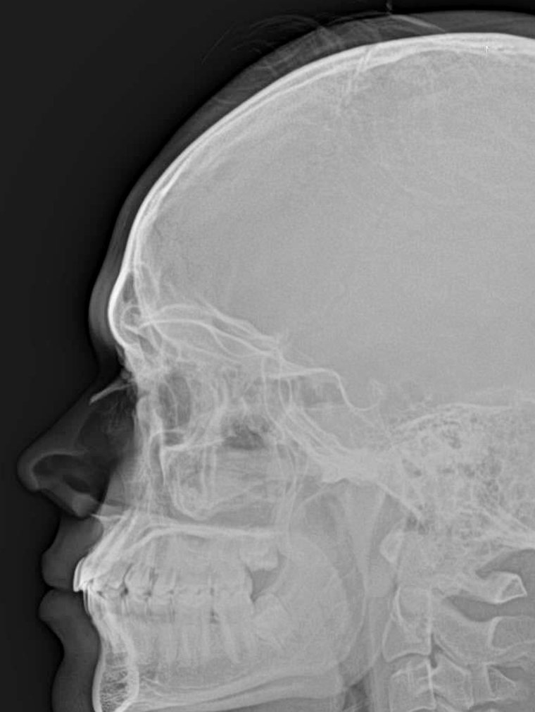 Radiografía de cráneo tomada por Radiografía Móvil en el domicilio del paciente